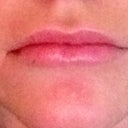 5 days after. Top still swollen in places