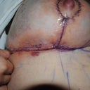 Underboob day 1 or 2 post op