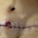 Tummy tuck.1 day post op