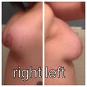 Side view (right side was smaller post op, left side larger)