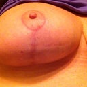 Taken 2-15, close up of right breast. almost 60 days post op