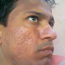 after 1 month. u will see my face. has dark spot