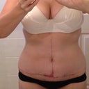 4.5 months post op.