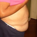 Before operation - 49 yrs old, 5'2", 183 lbs