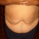 Before operation - 49 yrs old, 5'2", 183 lbs