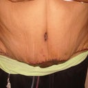 1 week after surgery - Dr. removed 5 lbs of skin and fat