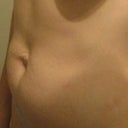 showing the canyon from muscle separation, and the bulgy hernia bellybutton.