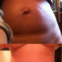 Im finally pisting a before and after. This is about 2.5 minths post op
