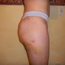 Right side 6 days after fat transfer