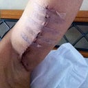 This is about 2 weeks post op.  Notice how the stitches seem squeezed and the skin pops out.  It flattens out completely later.