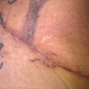 8 days after surgery... It was necessary for my incision to be extended.... But with beautiful incision, I know it wont be noticeable in a couple of months.