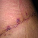 8 days after removal of dog ears and scar revision.
