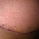 I love my thin beautiful incision.