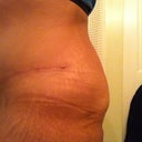 He would extend the incision about 3-4 inches I think and lift from the bottom and pull from the top.