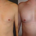 9 days post op (before and after)