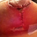 two weeks post op. after steri strip was taken off :( the beginning stages of wound separation