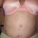 8 months post op