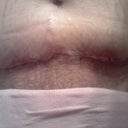 Week 3 - up close of scar. Looks a little infected