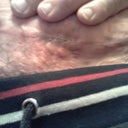 Week 8 - bumps below scar that showed up yesterday. From what I read, it's sutures coming to the surface. Tender to the touch!