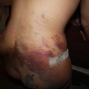 bad bruising and some swelling