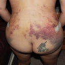 more bruising