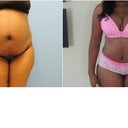 Before and 1 week After PO front.