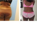 Before and 1 week After PO back.