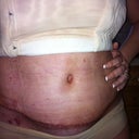 My spray which I love but here's my incision. I would also recommend these flesh colored panties. I bought 5 pair because they're so light and don't rub on my scar...