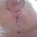 Right breast incision...this what happens when one over does it!