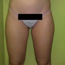 Before: Front.