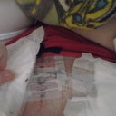 The dressing is stuck to my skin.