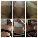 Before & After @ 5 weeks PostOp