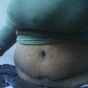 sorry for taking so long to post a after pic but this is like two after surgery 