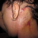 neck lift area