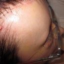 Brow lift staples, front to back of head