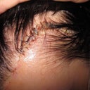 brow lift staples