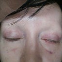 eyes not cut even, right eye cant shut and lower lid being dragged down 5 weeks post op