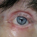 Lower right lid being dragged down causing much pain, both eyes swollen every day pulling on scar...5 weeks post op
