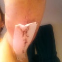 Left arm 1 week post op