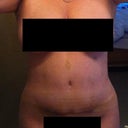 Please note the scar across my abdomen is from a tummy tuck in 2002