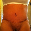 2 weeks post op and drains are gone!