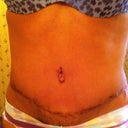 20 days post op!