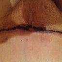 Close up of incision. Tape will come off next week