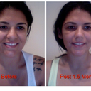 Another comparison. After shot is 1.5 months after surgery