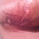 The right breast started healing also!!!