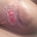 Left Breast as of 1/13/2013....LookS WAY WAY BETTER!!!