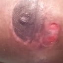 Right side. My problem area. It continues to open from time to time after it heals.