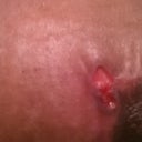 Left side. My problem area. It continues to open from time to time after it heals.