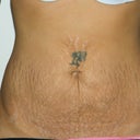The day of surgery (pre-op)