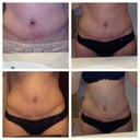 Scar progression wk 7